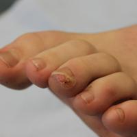 
	Subungual exostosis