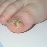 
	Subungual exostosis