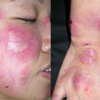 
	Sweet's syndrome - associated with pregnancy