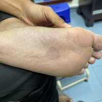 Secondary syphilis - same patient as previous…