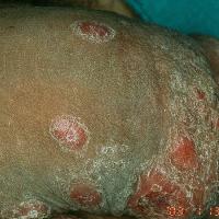 
	Condyloma lata in secondary syphilis

	Copied…