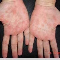 
	Secondary syphilis