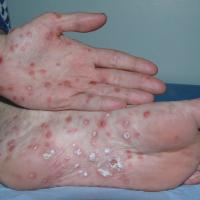 
	Secondary syphilis