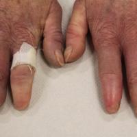 
	Systemic sclerosis - changes to the…