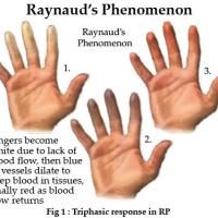 
	Raynaud's phenomenon
