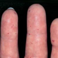 
	The CREST syndrome - telangiectases&nbsp;