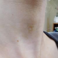 Terra firma-forme dermatosis 
Copied with kind…