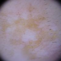 Dermoscopic appearance of previous figure
Copied…