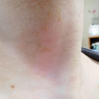 Same patient - scale removed with a…