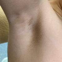 Terra firma-forme dermatosis - same…
