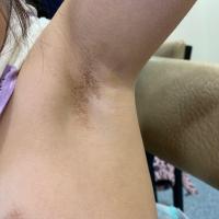Terra firma-forme dermatosis - same…