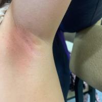 Terra firma-forme dermatosis - scale gently…
