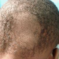 
	Tinea capitis - Tinea tonsurans isolated