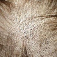 
	Tinea capitis - 'black dot ringworm'