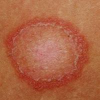 
	Tinea corporis

	Erythema and scale most…