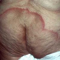 
	Extensive tinea corporis

	Given the extensive…