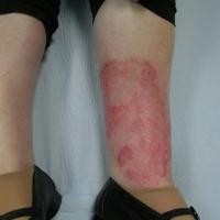 
	Tinea incognito

	Topical steroids aggravate…