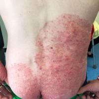 Tinea incognito
Copied with kind permission from…