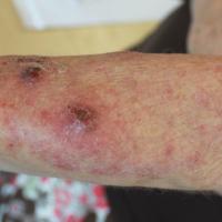 
	Tinea incognito

	With marked inflammatory…