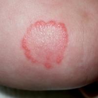 
	Tinea of the elbow

	Brother of patient in…