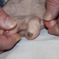 
	Tinea rubrum

	Confirmed by mycology…