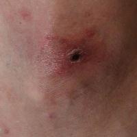 
	African tick-bite fever with an eschar