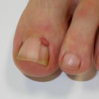 
	Periungual fibroma