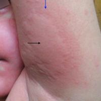 
	Acute urticaria - wheal and flare

	Wheal…