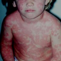 
	Acute urticaria