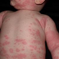
	Acute urticaria

	Copied with kind permission…