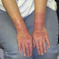 
	Latex allergy