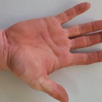 Delayed pressure urticaria
This man had a manual…