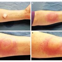 
	Cold urticaria

	The diagnosis was confirmed by…