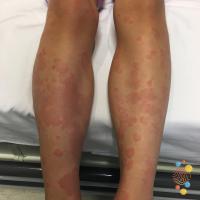 Chronic spontaneous urticaria
Copied with kind…