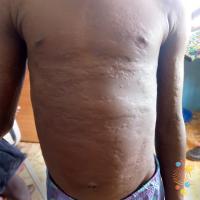 Chronic spontaneous urticaria
Copied with kind…