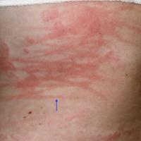 
	Spontaneous urticaria with dermographism…