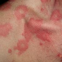 
	Spontaneous urticaria

	Copied with kind…