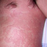 
	Spontaneous urticaria

	Copied with kind…