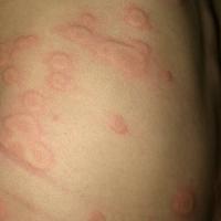 
	Spontaneous urticaria

	Copied with kind…