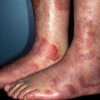 
	Urticarial vasculitis 

	Angulated lesions and…