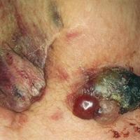 Angiosarcoma