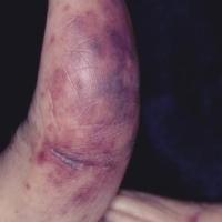 
	Retiform purpura