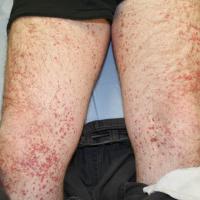 
	Cutaneous small vessel vasculitis

	Palpable…