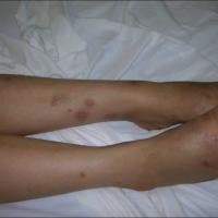 
	Churg-Strauss syndrome

	Tender subcutaneous…