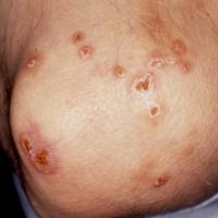 Churg-Strauss syndromeNodules (granuloma's) on…