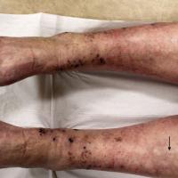 
	Cryoglobulinaemic vasculitis

	Palpable purpura…