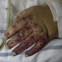
	Cryoglobulinaemic vasculitis