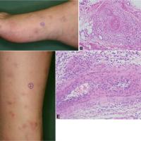 
	Cutaneous PAN

	(A) Purpuric cutaneous nodules…