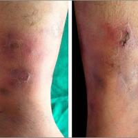 
	Cutaneous PAN