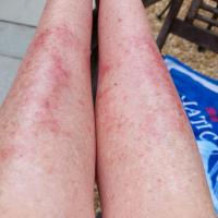 Exercise-induced vasculitis